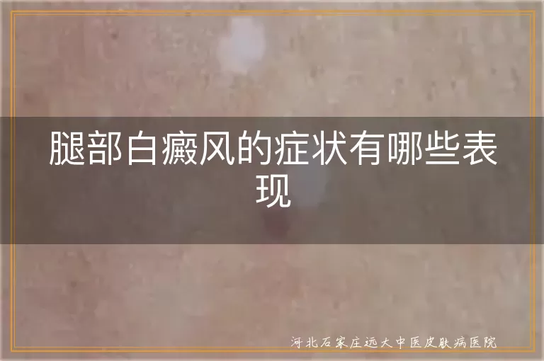 腿部白癜风的症状有哪些表现