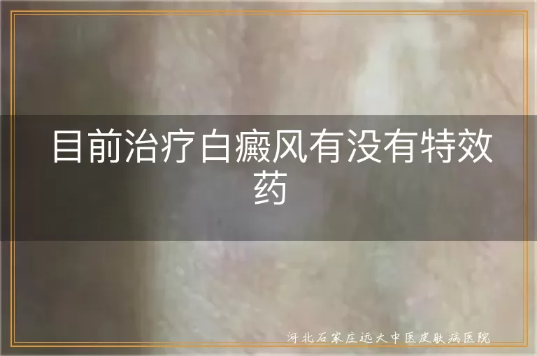 目前治疗白癜风有没有特效药