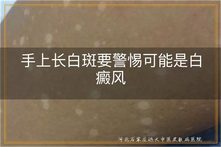 手上长白斑要警惕可能是白癜风