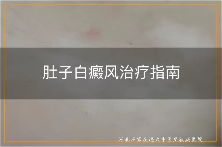 肚子白癜风治疗指南