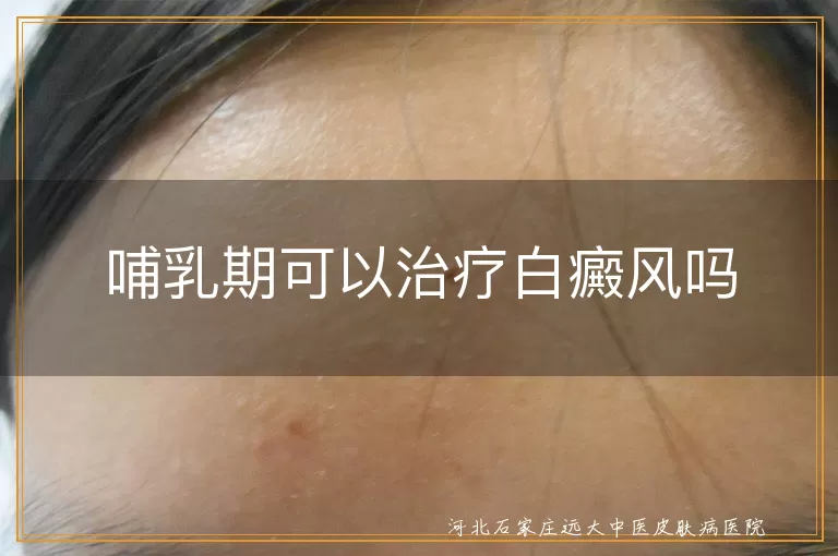 哺乳期可以治疗白癜风吗
