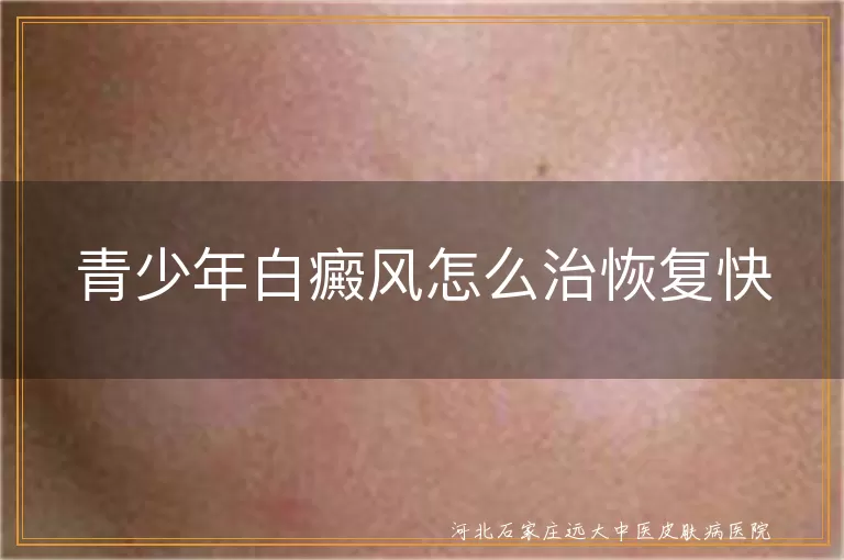 青少年白癜风怎么治恢复快