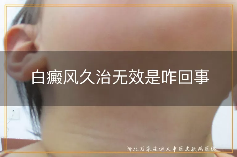 白癜风久治无效是咋回事