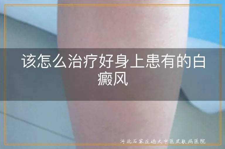 该怎么治疗好身上患有的白癜风
