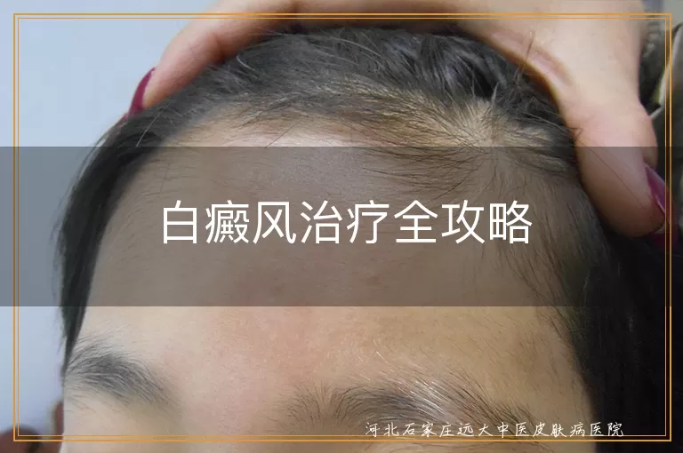 白癜风治疗全攻略