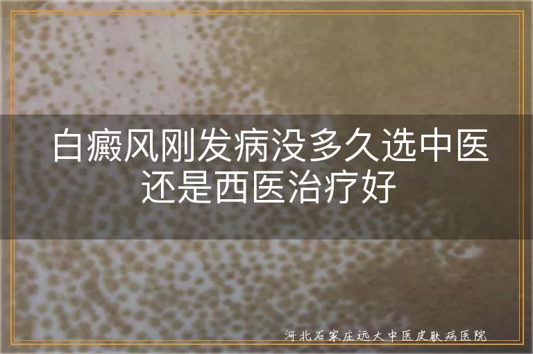 白癜风刚发病没多久选中医还是西医治疗好