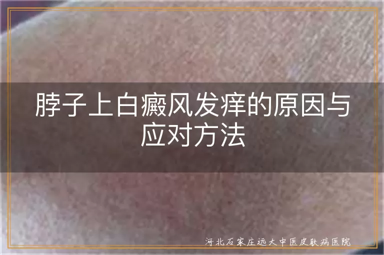 脖子上白癜风发痒原因,白癜风发痒应对,白斑瘙痒怎么办,白斑区域发痒处理