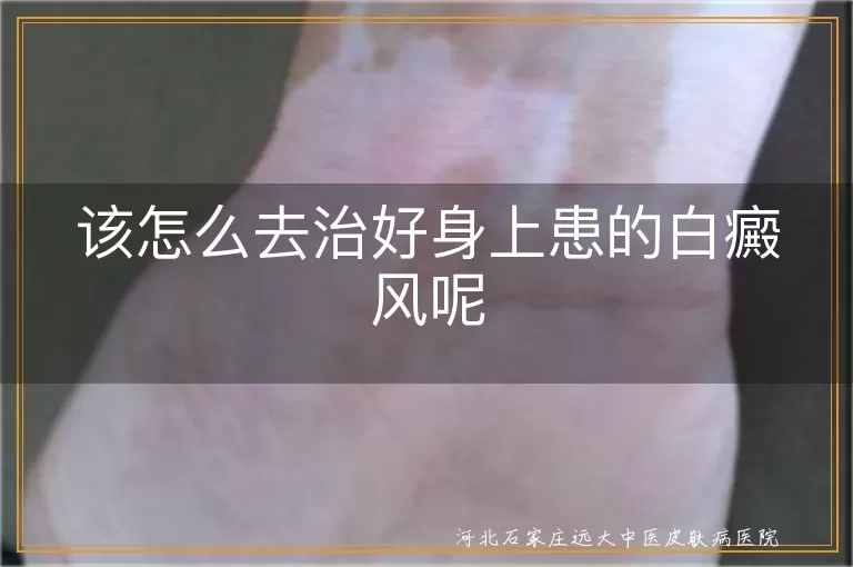 该怎么去治好身上患的白癜风呢