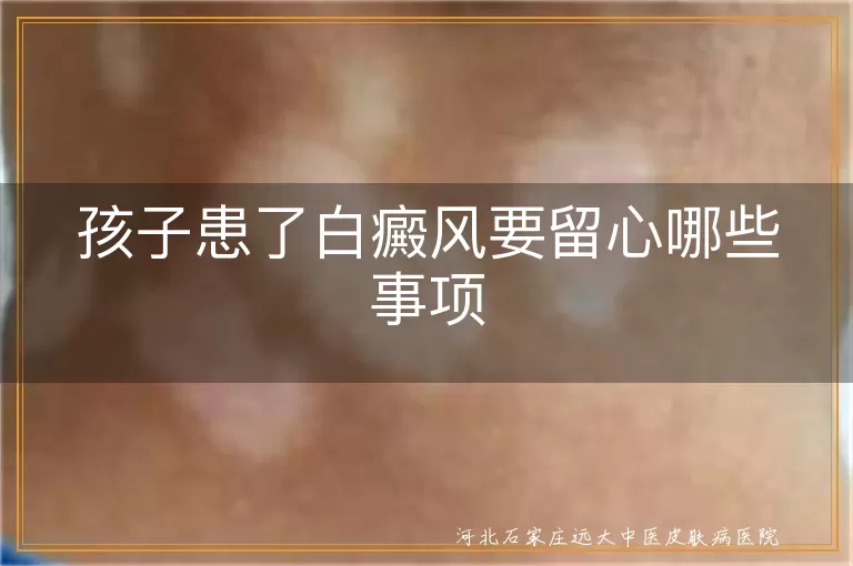 孩子患了白癜风要留心哪些事项