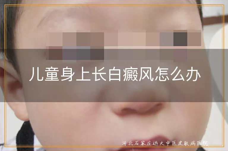 儿童白癜风治疗方法,白癜风药物治疗,白癜风光疗效果,白癜风生活护理