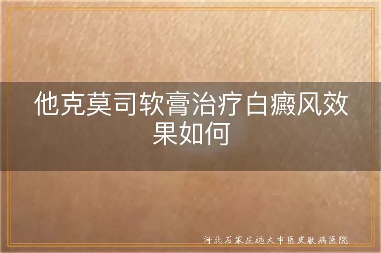 他克莫司软膏治疗白癜风效果如何