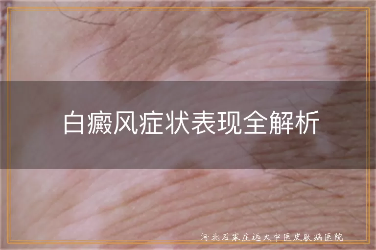 白癜风症状表现全解析