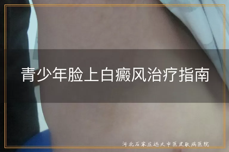 青少年脸上白癜风治疗指南