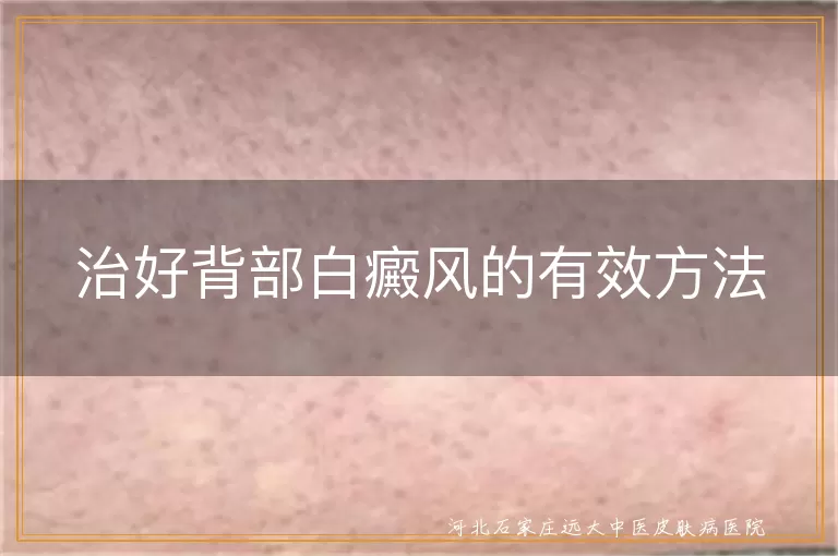 治好背部白癜风的有效方法