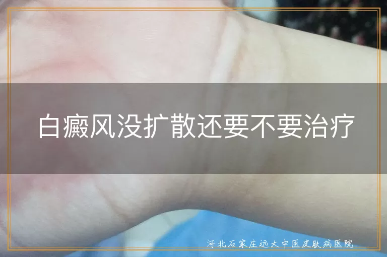 白癜风没扩散需治疗,白癜风影响美观健康,白癜风治疗方法多,治疗白癜风需耐心