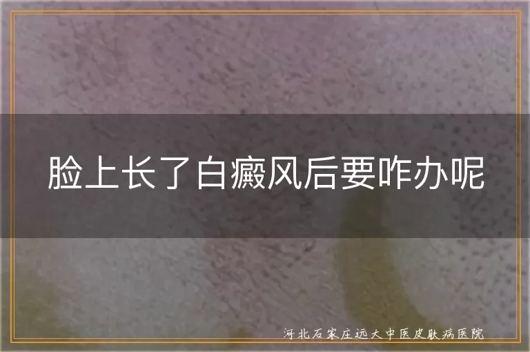 脸上白癜风治疗方法,白癜风患者饮食注意,白癜风防晒措施,白癜风中医治疗