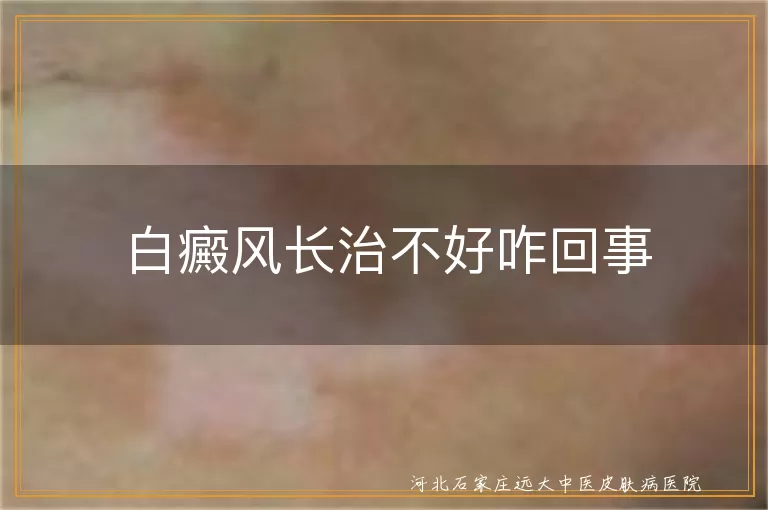 白癜风病因复杂难捉摸,白癜风治疗方法需对路,白癜风生活习惯心态很重要