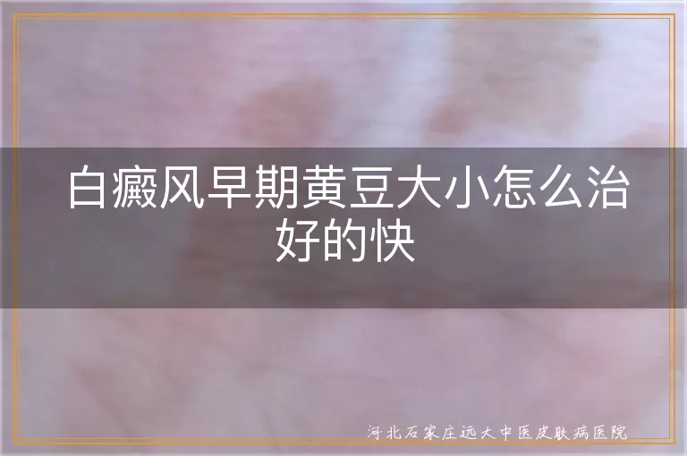 白癜风早期治疗,黄豆大白斑药物疗法,白斑光疗与心理调节