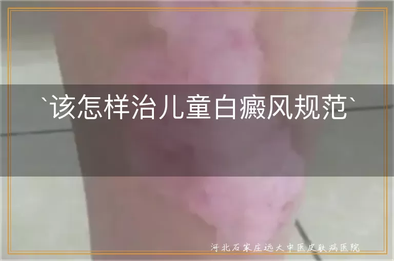 儿童白癜风治疗方法,白癜风儿童心理辅导,预防白癜风复发措施