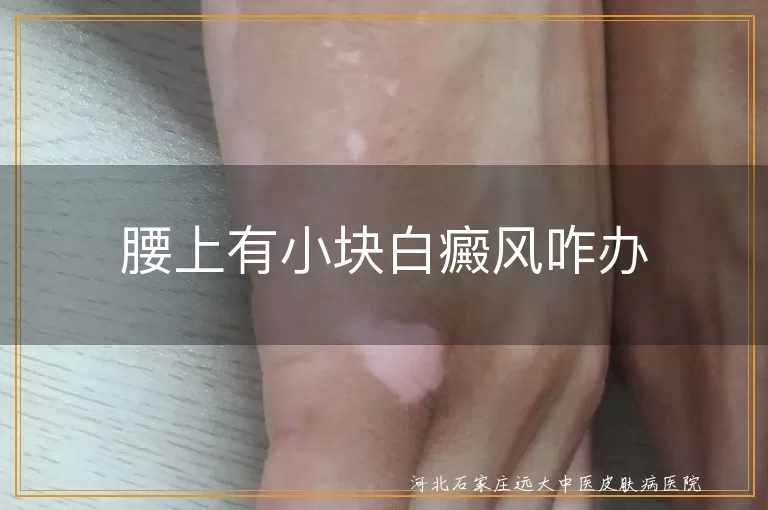 腰部长白癜风治法,小块白斑治疗建议,白癜风生活调理方法