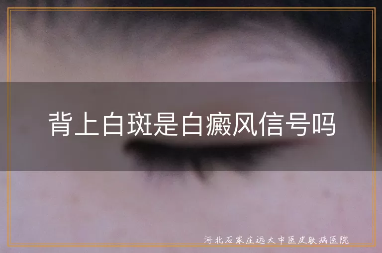 背上白斑与白癜风关系,白癜风白斑特点,预防白癜风方法