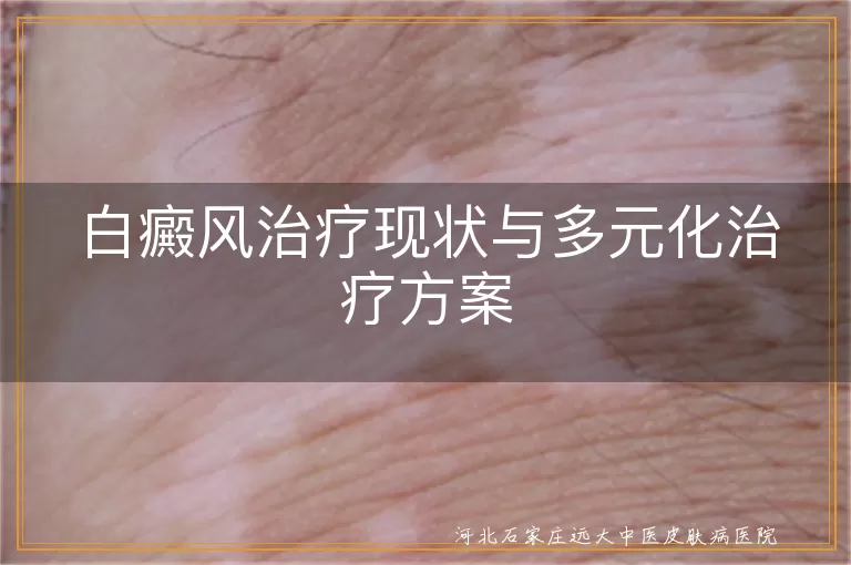 白癜风治疗新进展, 白斑多元化疗法, 白癜风综合治疗方案