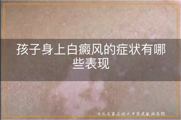 孩子白癜风症状,白斑表现特点,白癜风皮肤感觉异常