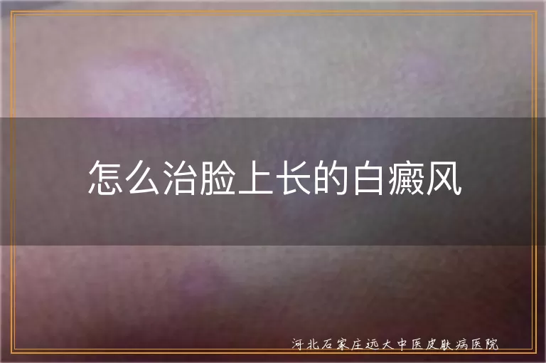 脸上白癜风治疗方法,白癜风药物治疗与光疗,白癜风生活调理与手术