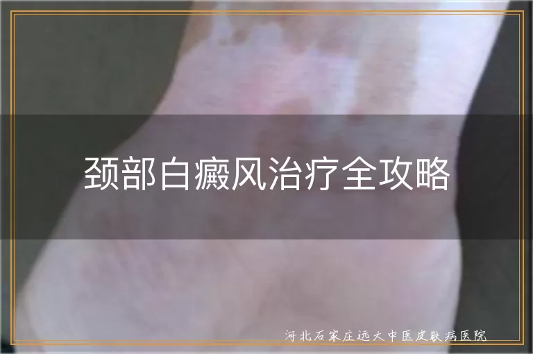 颈部白癜风治疗方法,白斑如何消除,白癜风生活护理