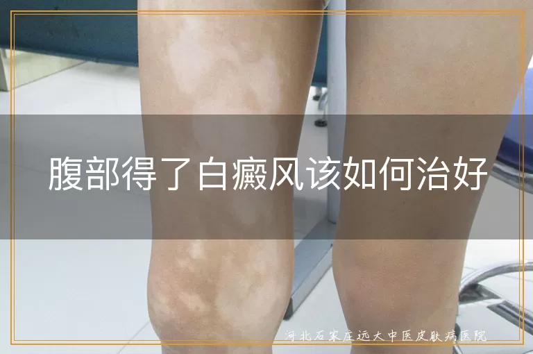 腹部白癜风治疗方法,白斑扩散应对,白癜风护理要点