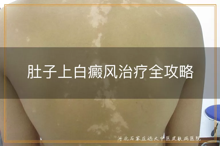 肚子白癜风药物治疗,白斑光疗效果,白癜风生活调理方法