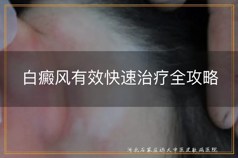 白癜风药物治疗,白癜风光疗辅助,白癜风生活调理