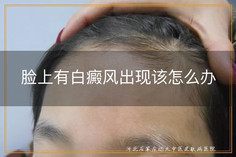 脸上白癜风如何应对,白斑日常护理方法,白癜风治疗建议