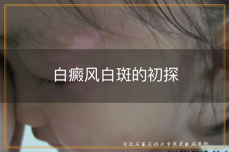 白癜风白斑特征,白斑分布与变化,白癜风治疗与护理