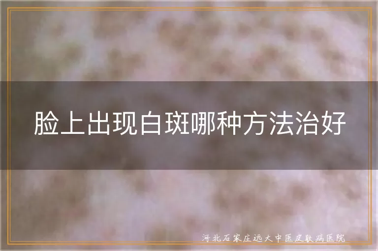 白癜风治疗方法,白斑有效治疗,脸上白斑治愈方法