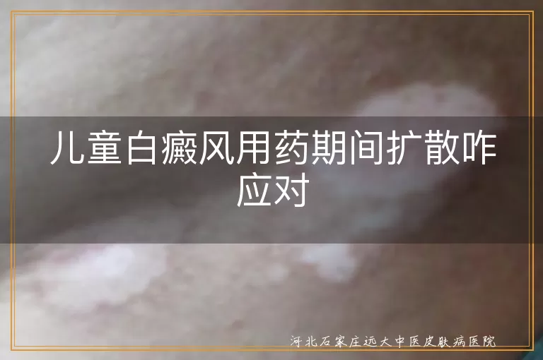 儿童白癜风扩散应对,白斑治疗期间扩散处理,儿童白斑扩散解决方法