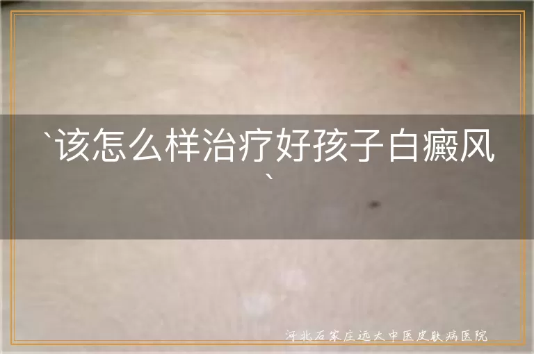 儿童白癜风治疗方法,白斑控制技巧,青少年白癜风护理建议