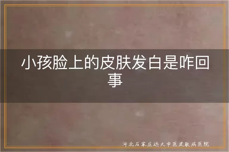 小孩脸上白斑原因,白癜风导致皮肤发白,小孩皮肤发白与白斑