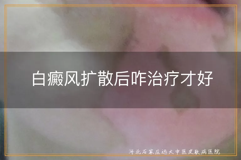 白癜风扩散治疗方法,白斑控制策略,白癜风辅助治疗方式