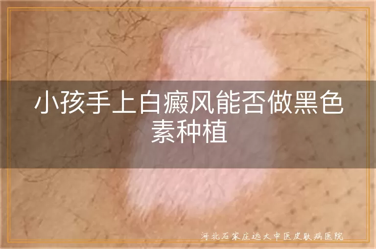 小孩白癜风黑色素种植效果, 手上白斑治疗方法, 儿童白癜风能否黑色素种植