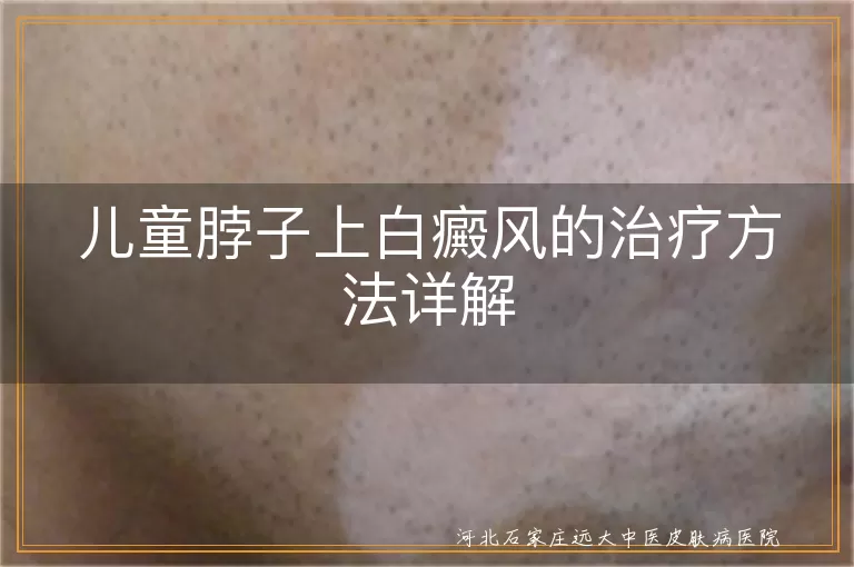 儿童白癜风治疗方法介绍,白斑儿童治疗详解,儿童白斑病治疗全解