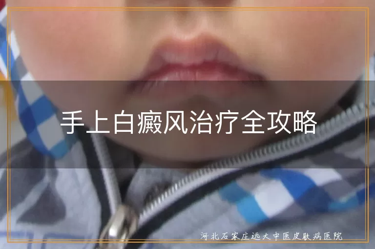 手上白癜风治疗方法,白斑药物治疗效果,白癜风光疗与手术选择