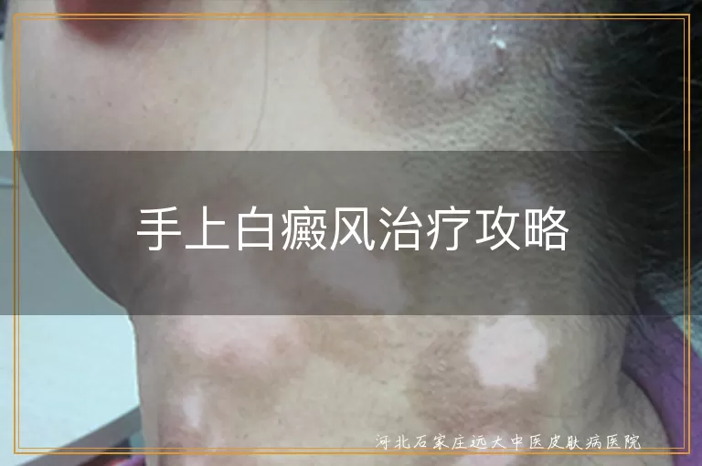 手上白癜风治疗方法,白癜风药物治疗,白斑光疗效果