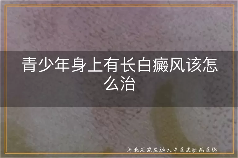 青少年白癜风治疗方法,白癜风日常护理建议,白癜风患者心理疏导