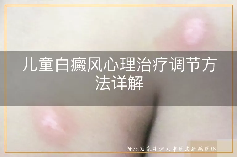 儿童白癜风心理调节,白斑儿童心理支持,白癜风患儿心理辅导