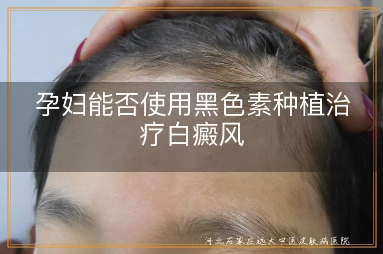 孕妇白癜风治疗选择,白斑孕妇能否黑色素种植,白癜风孕妇治疗方法