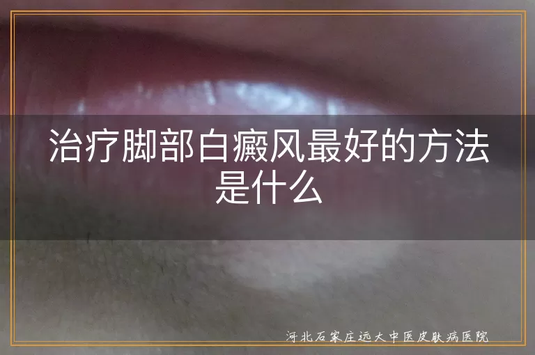 治疗脚部白癜风最好的方法是什么