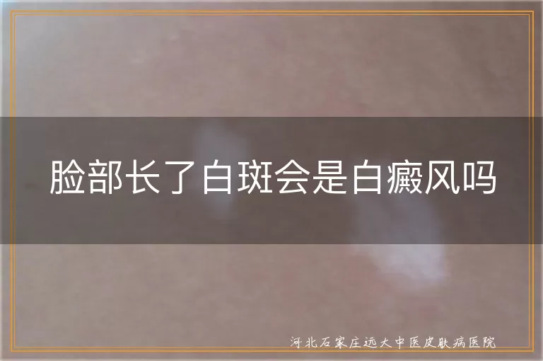 脸部长了白斑会是白癜风吗
