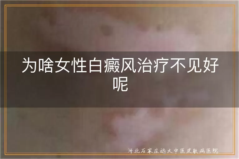 女性白癜风治疗难题,白斑治疗不见效原因,白癜风久治不愈因素