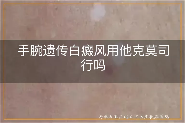 手腕遗传白癜风用他克莫司行吗